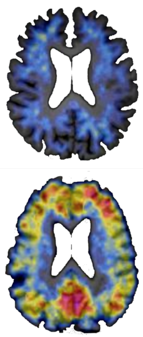 Human Amyloid Imaging